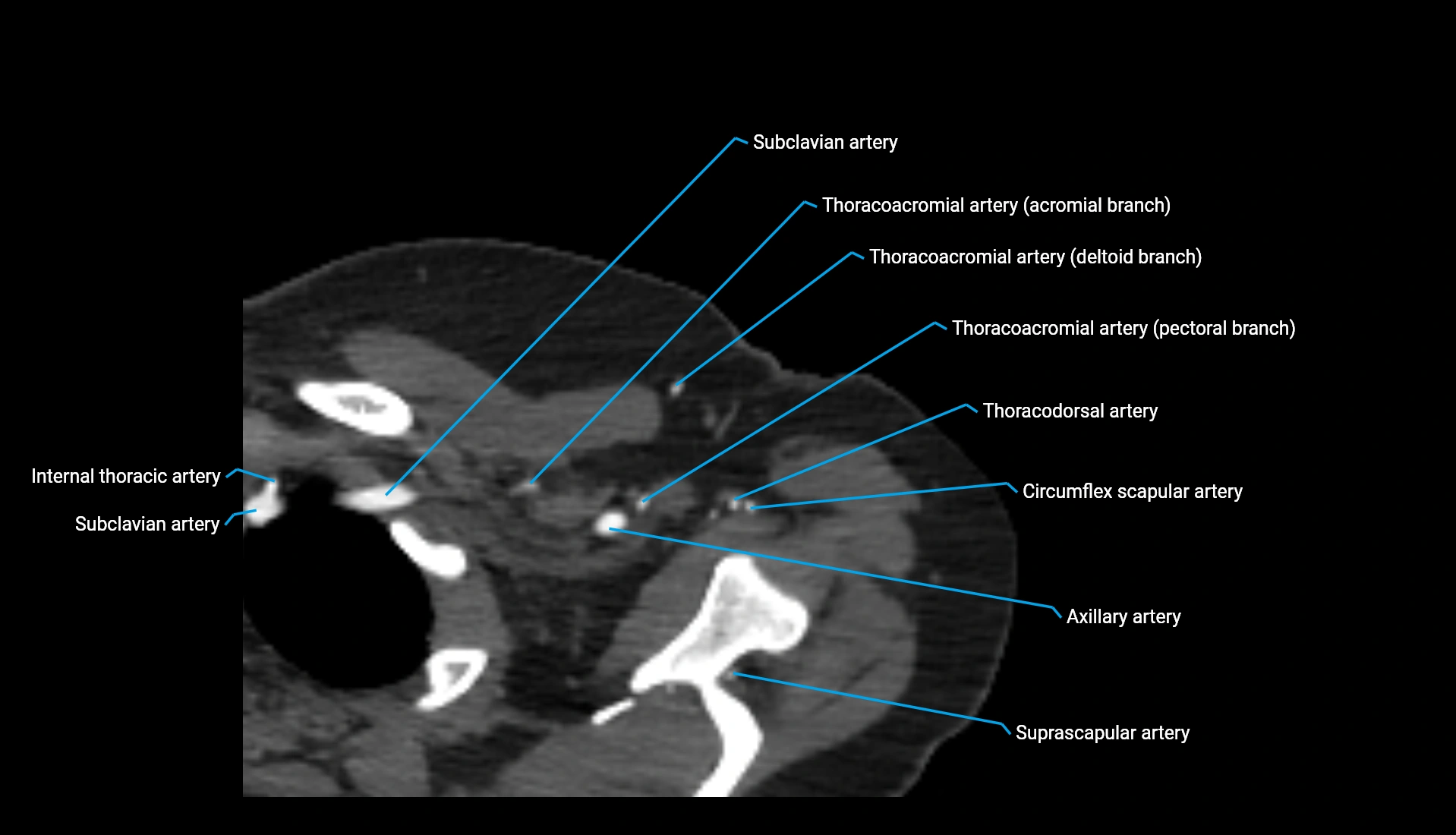 CTA upper limb axial cross sectional anatomy labelled image 334 (1).webp